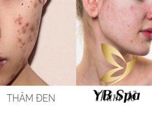 Mụn thâm đơn giản là những vết tối màu còn sót lại sau khi mụn đã rụng, thường là do mụn trứng cá, mụn viêm hoặc mụn bọc để lại.