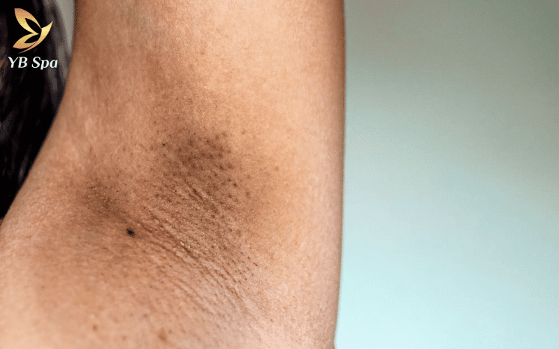 Hiểu rõ về PIH để thay đổi thói quen chăm sóc, giúp vùng da dưới cánh tay không còn thâm sùi và mất thẩm mỹ