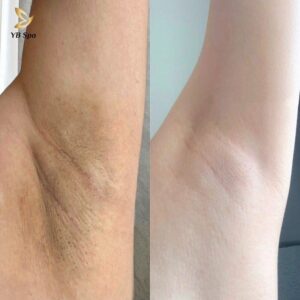 cách trị thâm nách tại nhà