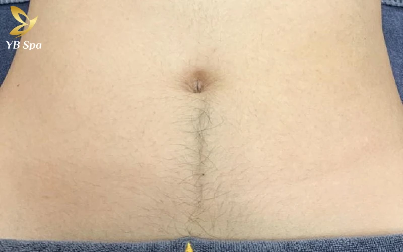 Phân biệt rõ các nguyên nhân khiến lông bụng phát triển mạnh sẽ giúp bạn quyết định có nên tự thực hiện triệt lông tại nhà hay không
