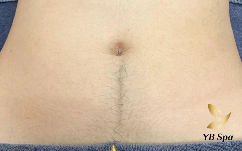 Những cách triệt lông bụng vĩnh viễn tại nhà an toàn, hiệu quả 18 Hình ảnh lông bụng