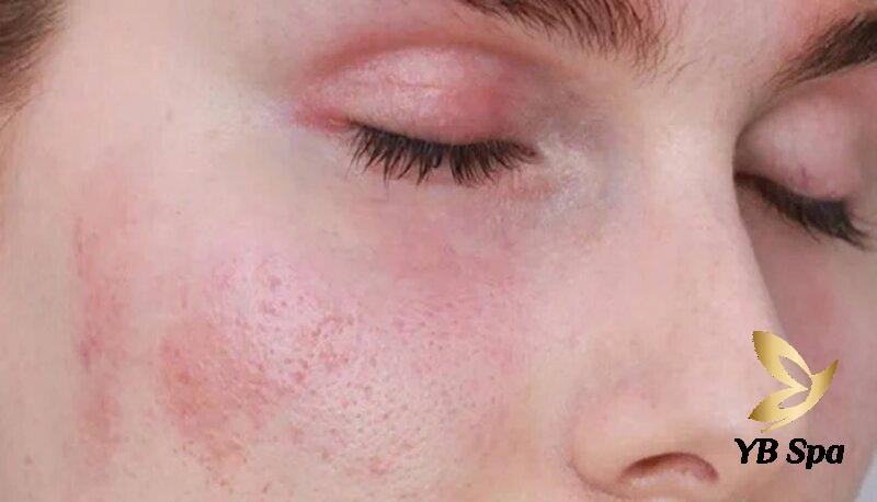 Cách Triệt Lông Mày Tại Nhà Hiệu Quả, An Toàn 26 Da nhạy cảm, dễ kích ứng