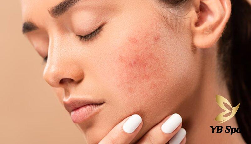 Cách Triệt Lông Mày Tại Nhà Hiệu Quả, An Toàn 27 Bệnh lý về da mặt