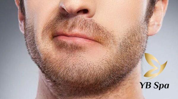 Những cách triệt ria mép ở nam giới