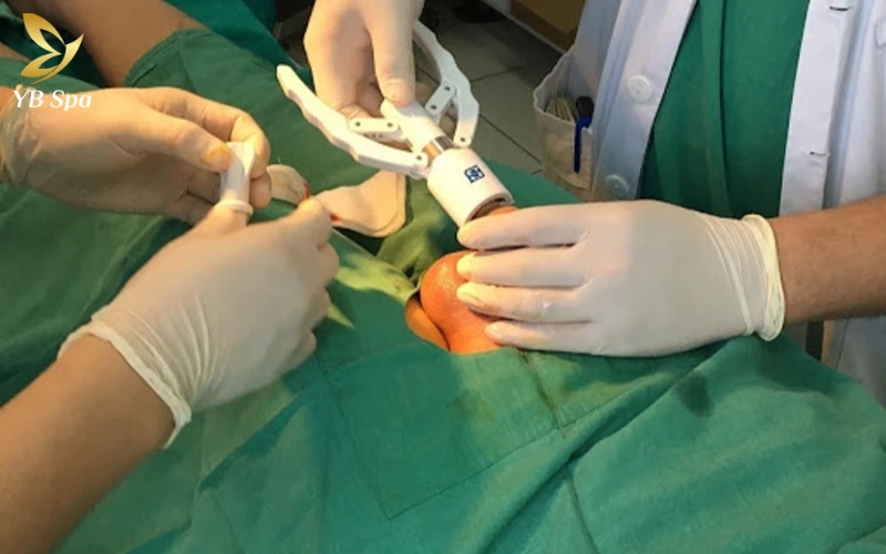 Cắt bao quy đầu có để lại sẹo không? Cách ngừa ngừa hiệu quả