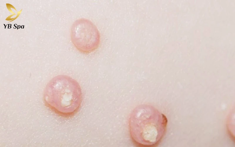 Cậu nhỏ nổi mụn trắng không ngứa là gì? Nguyên nhân và cách xử lý hiệu quả 22 Cậu nhỏ nổi mụn trắng không ngứa là gì? Nguyên nhân và cách xử lý hiệu quả