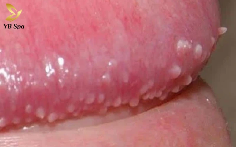 Cậu nhỏ nổi mụn trắng không ngứa là gì? Nguyên nhân và cách xử lý hiệu quả 23 Đặc điểm nhận biết cậu nhỏ nổi mụn trắng không ngứa