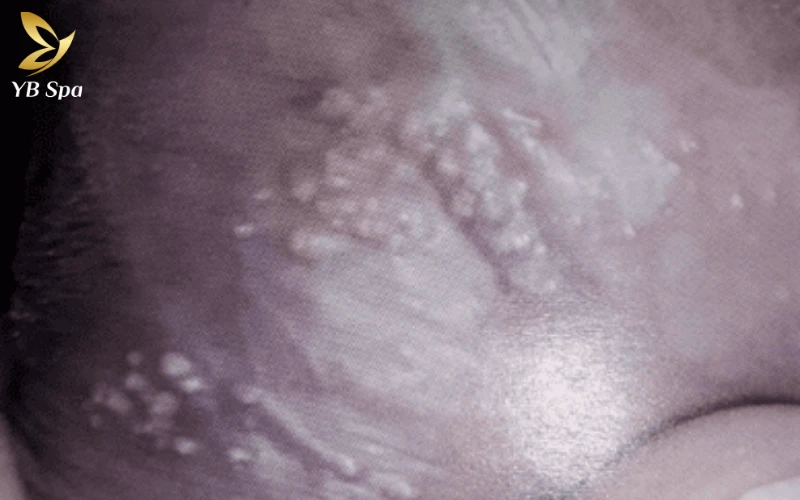 Cậu nhỏ nổi mụn trắng không ngứa là gì? Nguyên nhân và cách xử lý hiệu quả 24 Hạt Fordyce (tuyến bã nhờn lộ ra ngoài)