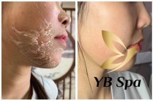 Peel da là gì? Peel da có tốt không?