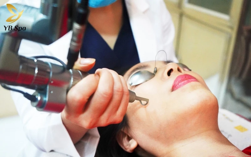 chi phí trị nám bằng laser