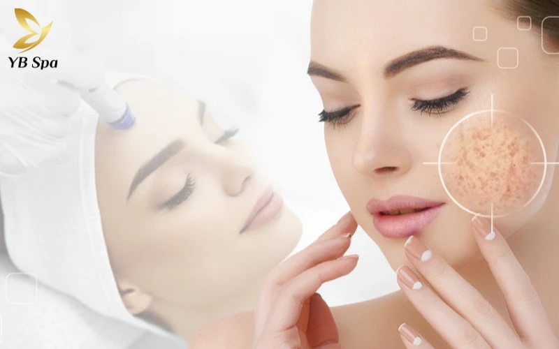 Chi phí trị nám bằng laser là bao nhiêu?