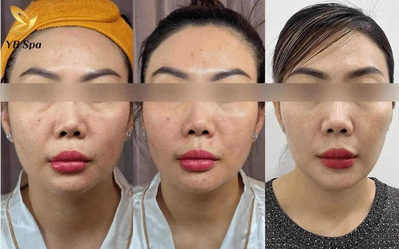 Diện mạo trẻ trung quay trở lại với đường viền hàm sắc nét và làn da căng mịn ngay sau lần đầu trải nghiệm dịch vụ tại YB Spa