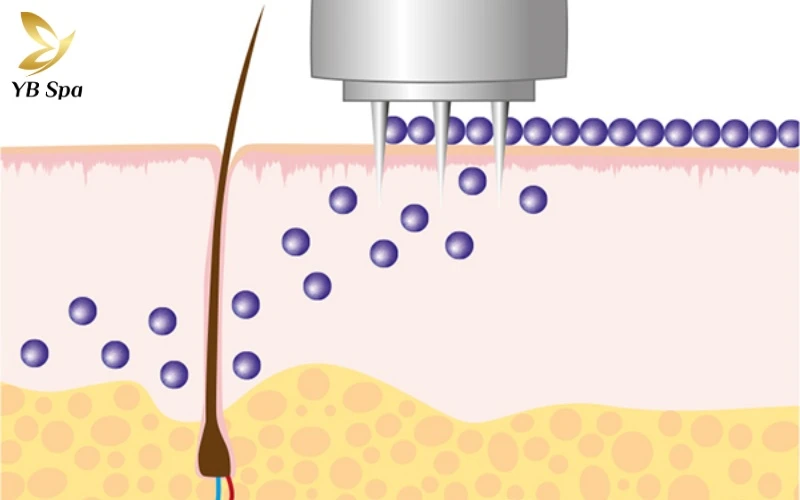 Cơ chế phục hồi da của Mesotherapy hoạt động như thế nào? 14 Những vi tổn thương có kiểm soát từ đầu kim Meso chính là "ngòi nổ" đánh thức các tế bào đang nghỉ ngơi bước vào trạng thái hoạt động và tái tạo tích cực