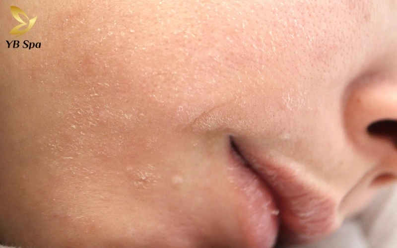 Cơ chế phục hồi da của Mesotherapy hoạt động như thế nào? 19 Đối với da khô bẩm sinh, tiêm Meso HA là cách nhanh nhất để tái thiết lập độ ẩm tự nhiên và trả lại vẻ mịn màng vốn có