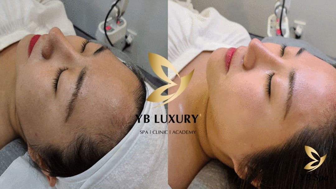 Có nên cạo lông mặt không? Cách cạo lông mặt an toàn tại nhà 32 Phương pháp triệt lông bằng laser giúp loại bỏ hoàn toàn nang lông mà không gây đau rát