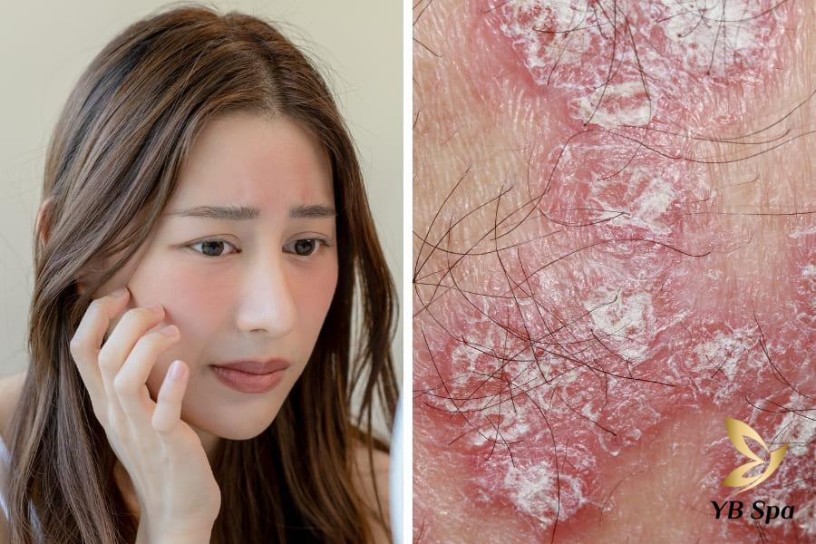 Có nên cạo lông mặt không? Cách cạo lông mặt an toàn tại nhà 25 cạo sai kỹ thuật hoặc sử dụng dao không được vệ sinh kỹ lưỡng có thể gây ra những vấn đề như tổn thương da