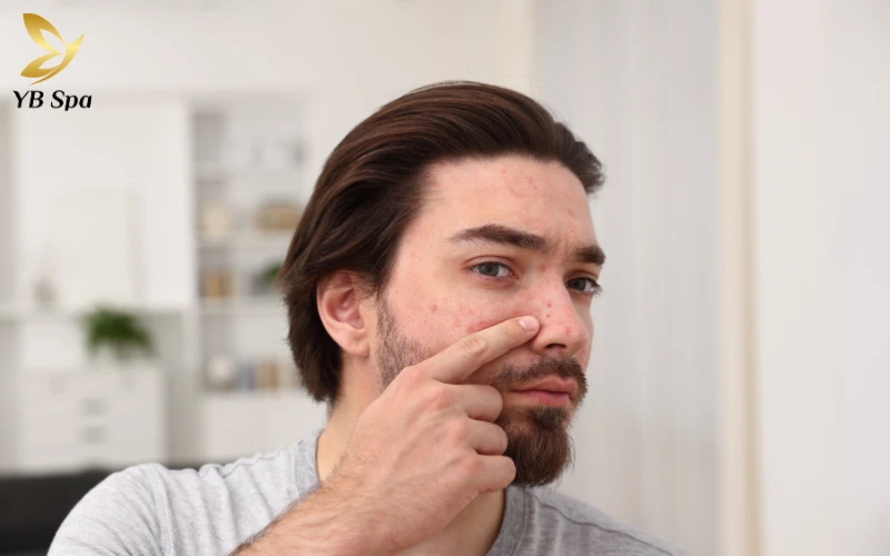 Tuyệt đối không chạm tay lên mặt hoặc cạy vảy sớm để tránh gây ra các vết sẹo lõm và thâm mụn khó điều trị