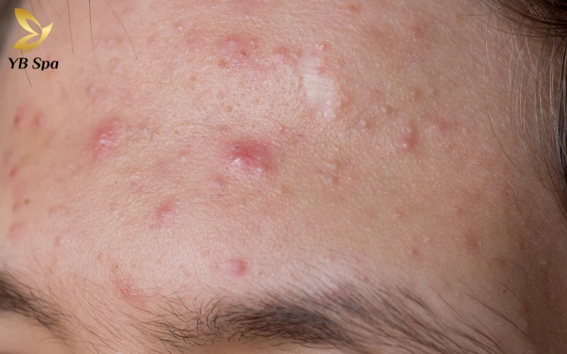 Đừng tự nặn mụn mủ tại nhà, hãy để chuyên gia giúp bạn dọn sạch ổ dịch trong môi trường vô trùng chuẩn y khoa