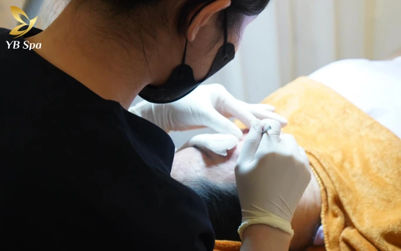 Phương pháp lấy mụn hiện đại tại YB Spa thay thế hoàn toàn cây nặn kim loại để bảo vệ cấu trúc da, tránh nguy cơ để lại sẹo