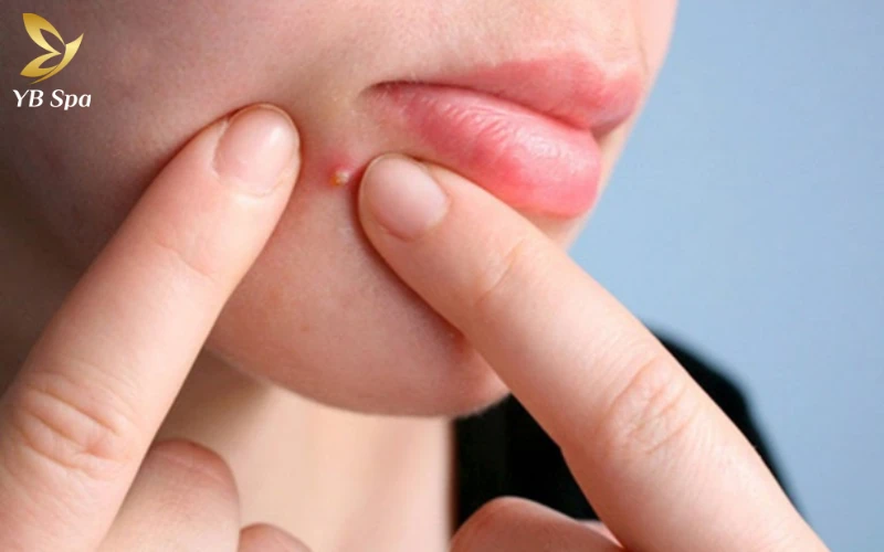 Có Nên Nặn Mụn Mủ Không? Quy Trình Nặn Mụn Mủ An Toàn Tại Nhà 21 Có Nên Nặn Mụn Mủ Không?