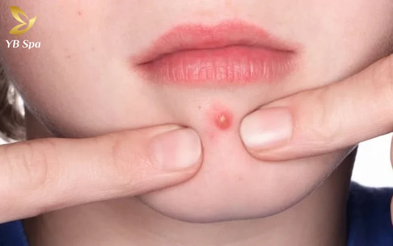 Có Nên Nặn Mụn Mủ Không? Quy Trình Nặn Mụn Mủ An Toàn Tại Nhà 22 Mụn Mủ ở cằm