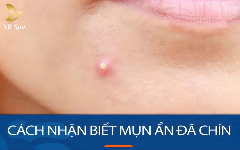 Có Nên Nặn Mụn Mủ Không? Quy Trình Nặn Mụn Mủ An Toàn Tại Nhà 23 Mụn Đã Chín Hoàn Toàn