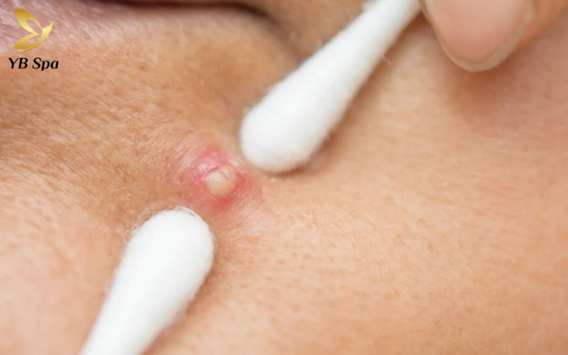 Có Nên Nặn Mụn Mủ Không? Quy Trình Nặn Mụn Mủ An Toàn Tại Nhà 25 Nặn Mụn Nhẹ Nhàng