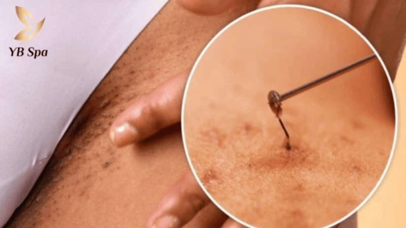 Có Nên Nhổ Lông Vùng Kín Không? Những Rủi Ro Và Hậu Quả Tiềm Ẩn 11 Tình trạng lông mọc ngược gây ngứa ngáy, khó chịu và hình thành các nốt sưng viêm