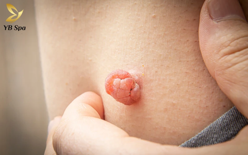 Có nên đốt mụn thịt không? Giải đáp chi tiết từ chuyên gia 20 Có nên đốt mụn thịt không