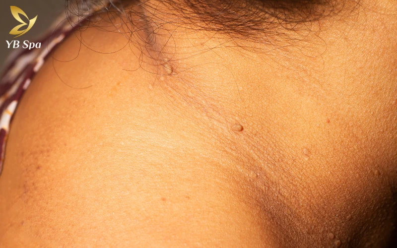 Có nên đốt mụn thịt không? Giải đáp chi tiết từ chuyên gia 21 Mụn thịt là gì