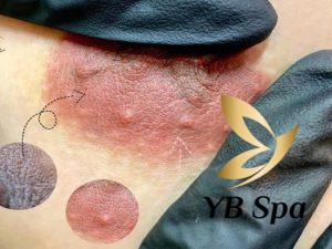 Có nên peel da làm hồng nhũ hoa không? Ai nên và không nên peel?