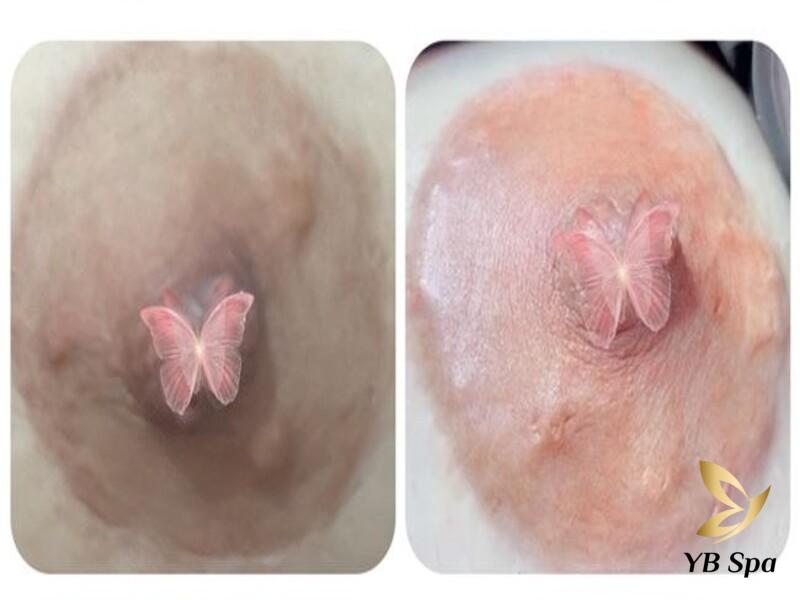 Có nên peel da làm hồng nhũ hoa không? Ai nên và không nên peel? 20 peel nhũ hoa được thiết kế để đảm bảo sự an toàn tối đa cho vùng da nhạy cảm với các sản phẩm và kỹ thuật được kiểm soát chặt chẽ