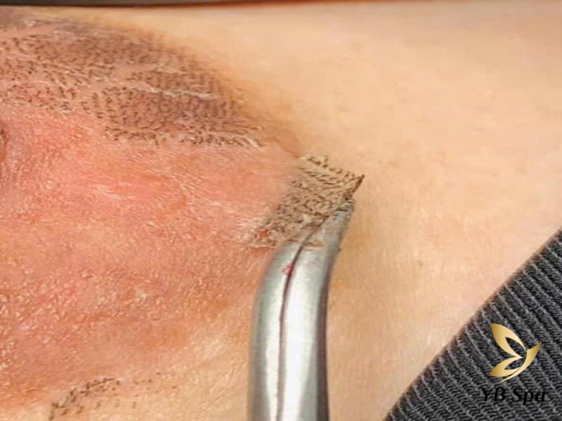 Có nên peel da làm hồng nhũ hoa không? Ai nên và không nên peel? 21 sau 5 đến 7 ngày nhũ hoa sẽ bong ra và lấy lại vẻ hồng hào tự nhiên.