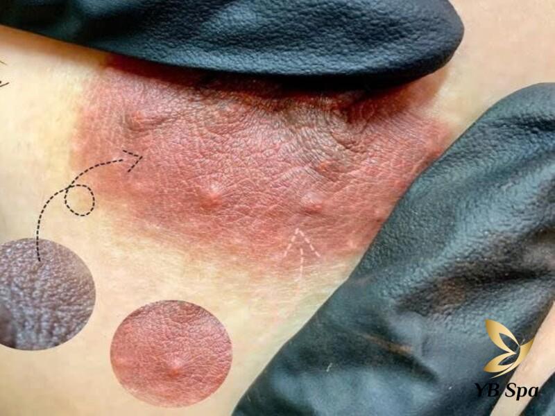 Có nên peel da làm hồng nhũ hoa không? Ai nên và không nên peel? 18 Peel da làm hồng nhũ hoa là một giải pháp đặc biệt giúp trẻ hóa, làm hồng vùng nhũ hoa