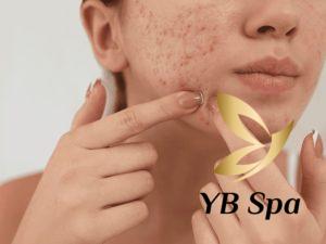 Có nên Peel da sau khi nặn mụn? Khi nào Peel da thì tốt?