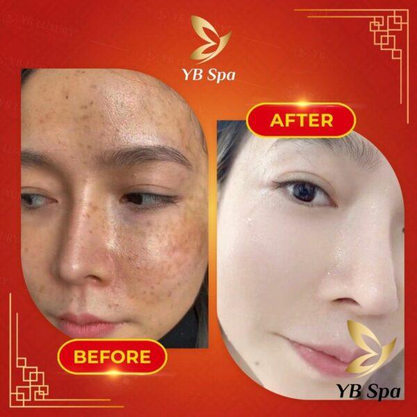 Tiêm meso tại YB Spa là quyết định sáng suốt (Nguồn: YB Spa)