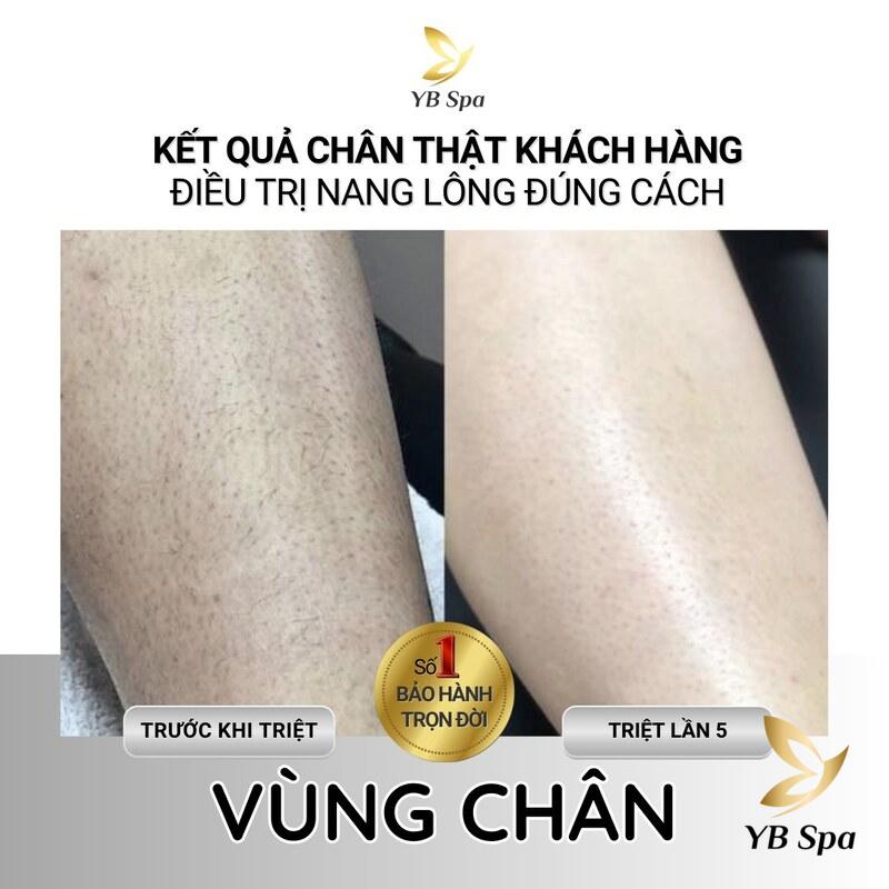 Có nên triệt lông chân? Lông chân có tác dụng gì? 26 Triệt lông chân bằng công nghệ cao giúp kéo dài thời gian lông mọc lại lâu nhất có thể (Nguồn: YB Spa)
