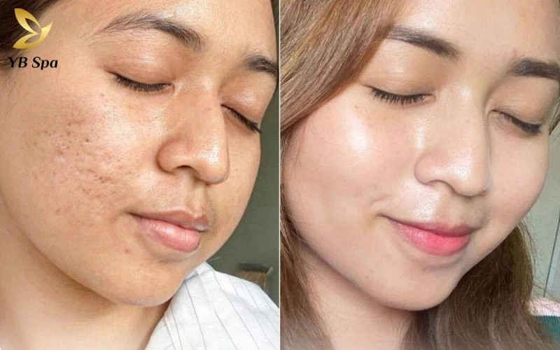 Cocktail Meso là gì? Cơ chế hoạt động của Cocktail Meso 25 Sau 2–4 tuần, Cocktail Meso đạt độ "chín" giúp làn da căng bóng và thu nhỏ lỗ chân lông rõ rệt