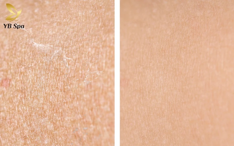 Cocktail Meso là gì? Cơ chế hoạt động của Cocktail Meso 20 Sự kết hợp hoàn hảo giữa HA và acid amin giúp tái tạo hàng rào ẩm, mang lại làn da mọng mướt ngay sau liệu trình