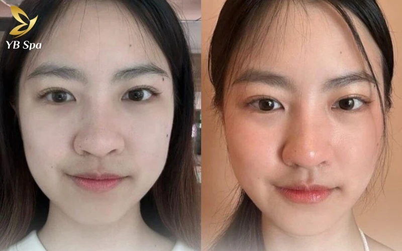 Cocktail Meso là gì? Cơ chế hoạt động của Cocktail Meso 22 Khách hàng sở hữu đường nét khuôn mặt thanh tú cùng làn da mọng mướt sau khi thực hiện tiêm Meso chuyên sâu tại YB Spa