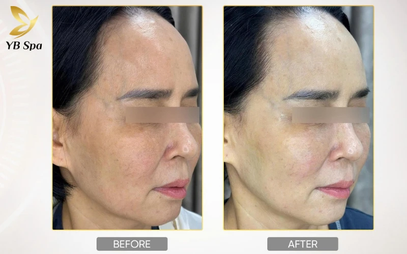 Không cần dao kéo, Density RF mang lại vẻ đẹp trẻ trung, tự nhiên và các đường nét gương mặt trở nên sắc sảo hơn sau liệu trình