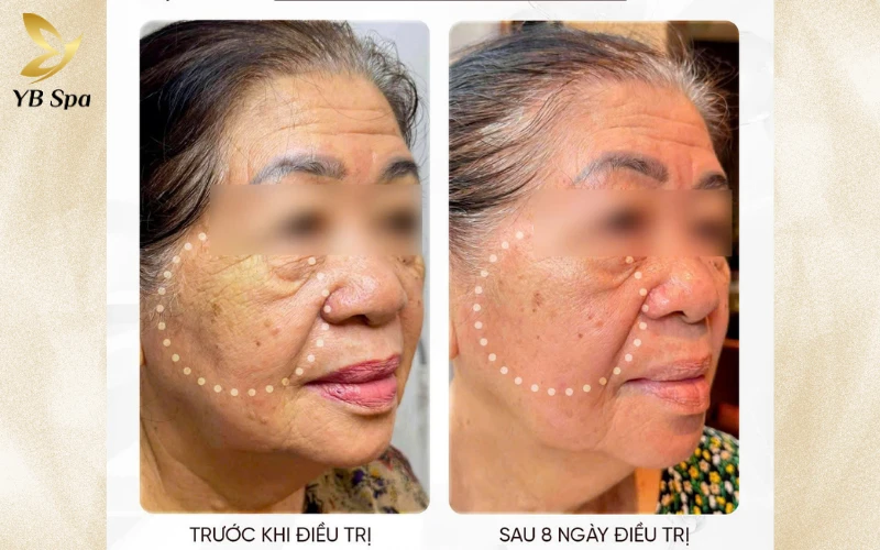 Kết quả thực tế từ khách hàng tại YB Spa là lời khẳng định chắc chắn nhất cho hiệu quả trẻ hóa đa tầng của công nghệ Density RF