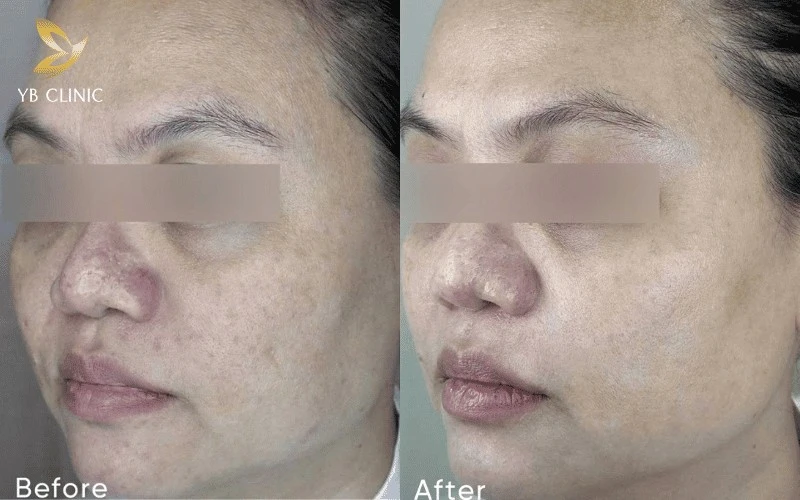 Top 8 Công Nghệ Trẻ Hóa Da Không Xâm Lấn Tốt Hiện Nay 9 Trẻ hóa da đa tầng với công nghệ Density giúp siết cơ mặt, xóa nếp nhăn tĩnh an toàn, không đau.