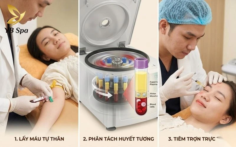 PRP (Huyết tương giàu tiểu cầu)