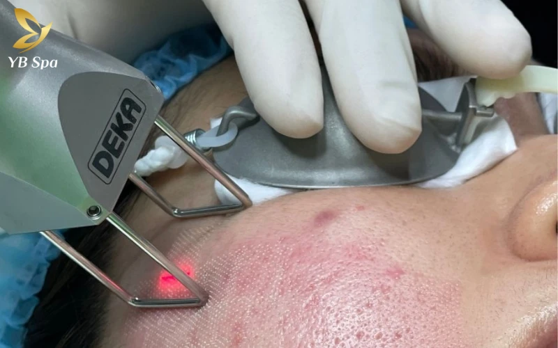 Top 7 Công nghệ trị sẹo rỗ tốt hàng đầu hiện nay 24 Laser CO2 Fractional