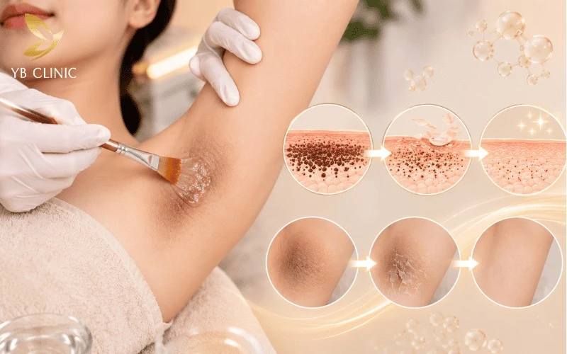 Top 5 Công Nghệ Trị Thâm Nách Phổ Biến Hiện Nay 8 Peel da hóa học hoạt động bằng cách kiểm soát quá trình bong sừng, thúc đẩy tái tạo da mới và hỗ trợ làm đều màu vùng da dưới cánh tay.