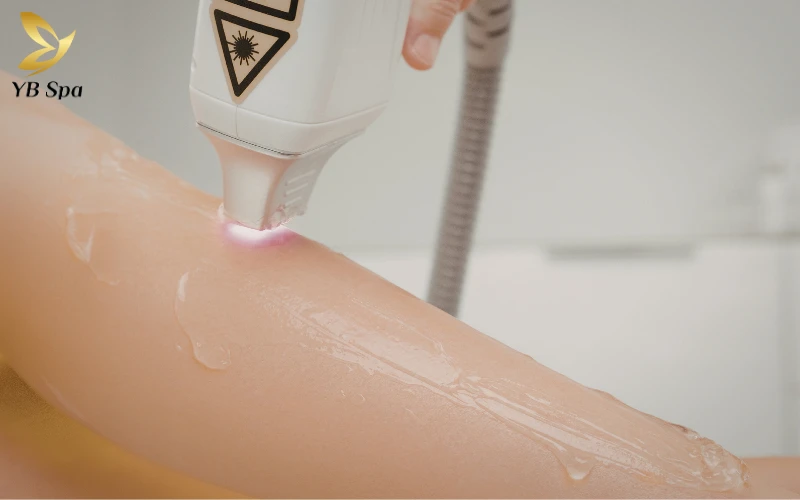 Đón đầu xu hướng thẩm mỹ 2026 bằng 5 công nghệ triệt lông vĩnh viễn hiện đại, giúp loại bỏ nang lông tận gốc và nuôi dưỡng làn da mịn màng