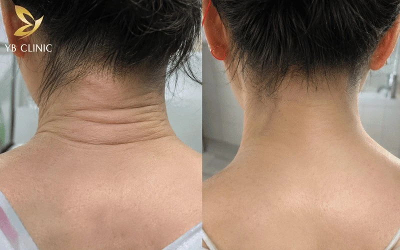 Elight và IPL hỗ trợ cải thiện sắc tố, làm đều màu và giúp vùng da gáy sáng mịn hơn.