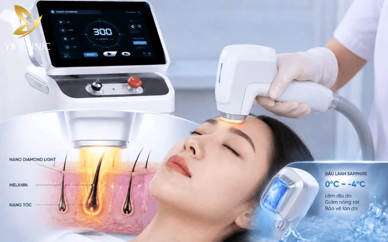 Top 5 Công Nghệ Triệt Tóc Trán Được Đánh Giá Cao 6 Nano Diamond Light sử dụng ánh sáng chọn lọc tác động vào melanin trong nang tóc, giúp làm suy yếu gốc tóc và hỗ trợ tạo đường chân tóc gọn gàng.