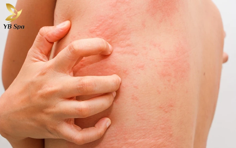 Da bị ngứa gãi nổi hột